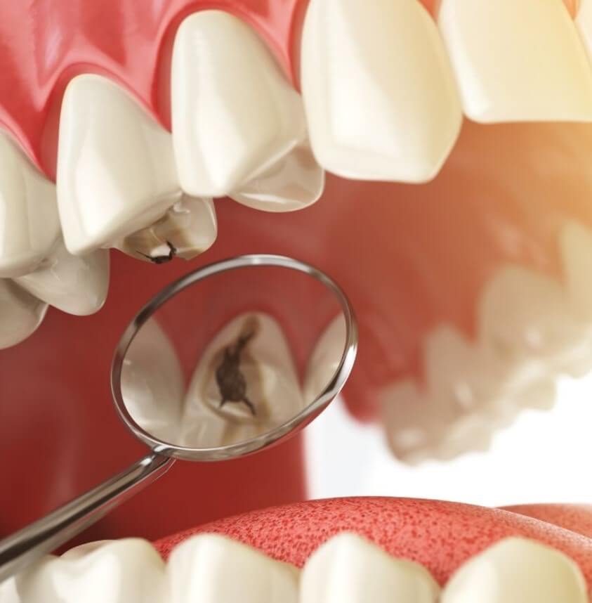 Benefits of Endodontic Treatment with Top Brooklyn Root Canal Specialists 