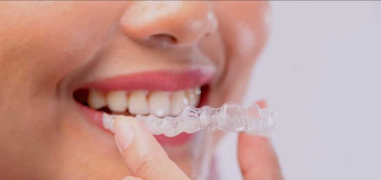 Best Invisalign® in Brooklyn, NY Cost, Insurance, Self-Pay Options, Types | Invisalign vs. Braces | ParkSide Dental