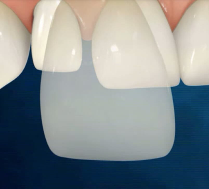 Lumineers with Best Brooklyn Dentist, cost, insurance, benefits