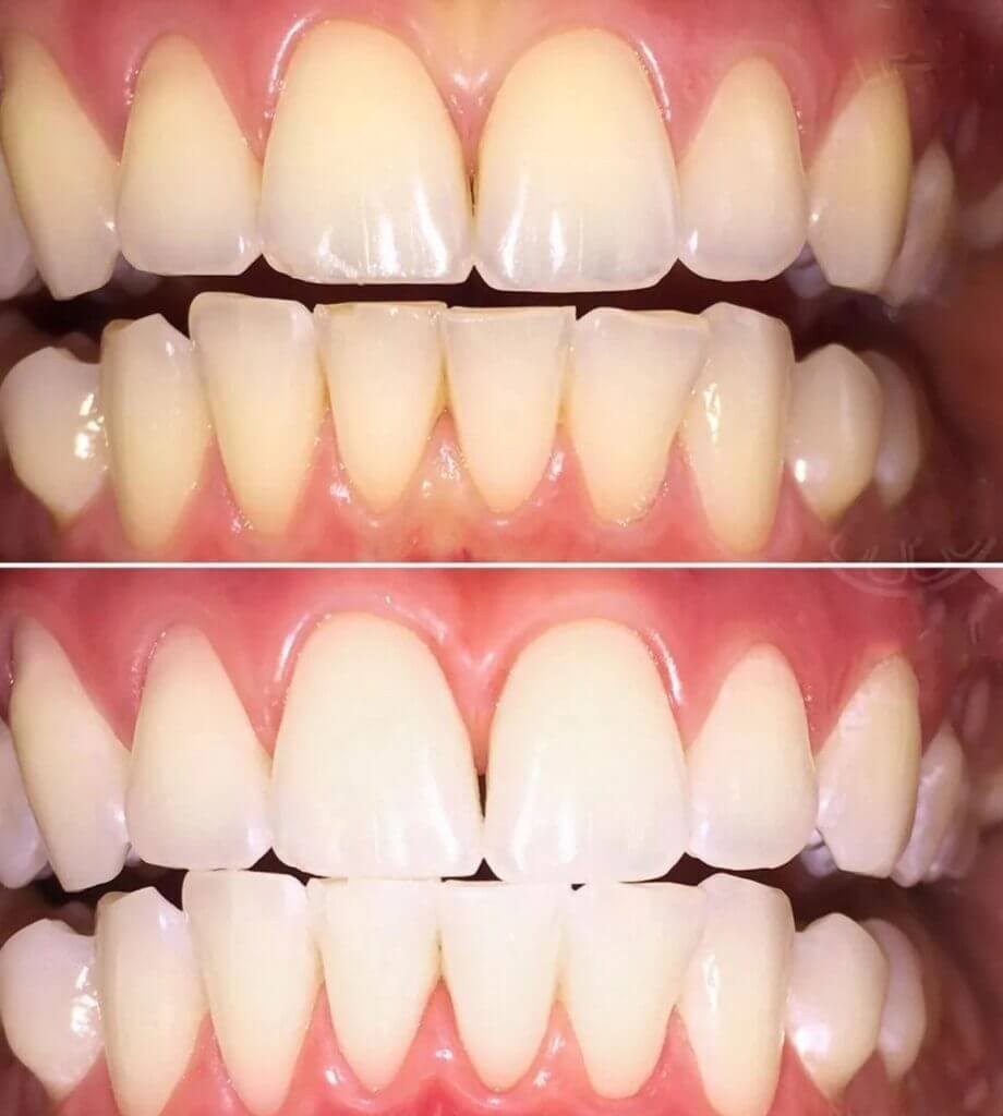 Are There Any Side Effects Associated with Whitening Treatments?