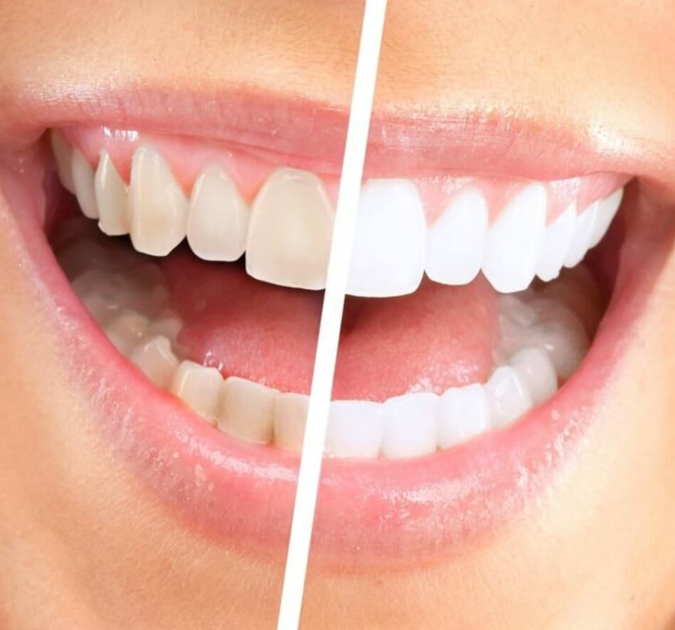 Can Discolored Yellow Teeth Be Whitened?