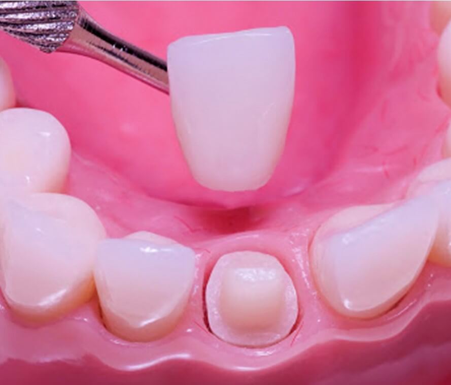 Veneers vs. Crowns What’s the Difference Brooklyn Dentist