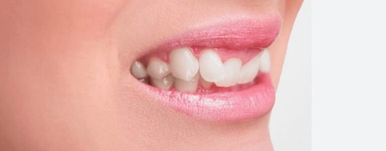 Best Brooklyn Crooked Teeth Treatment | Insurance, Cost, Self-pay options | Dentist Dr. Moskalenko