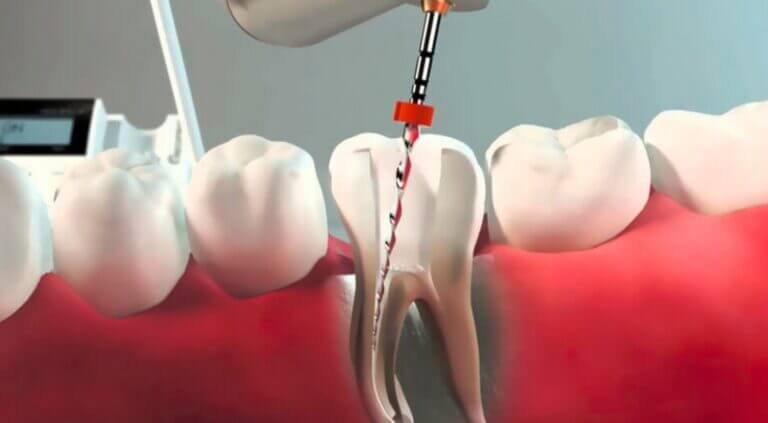 Debunking Myths: Root Canals and Cancer – Separating Fact from Fiction