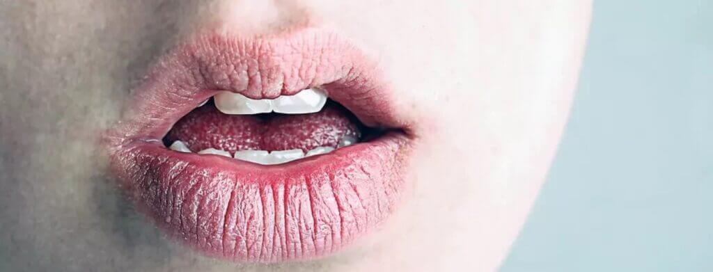 Dry Mouth (Xerostomia)