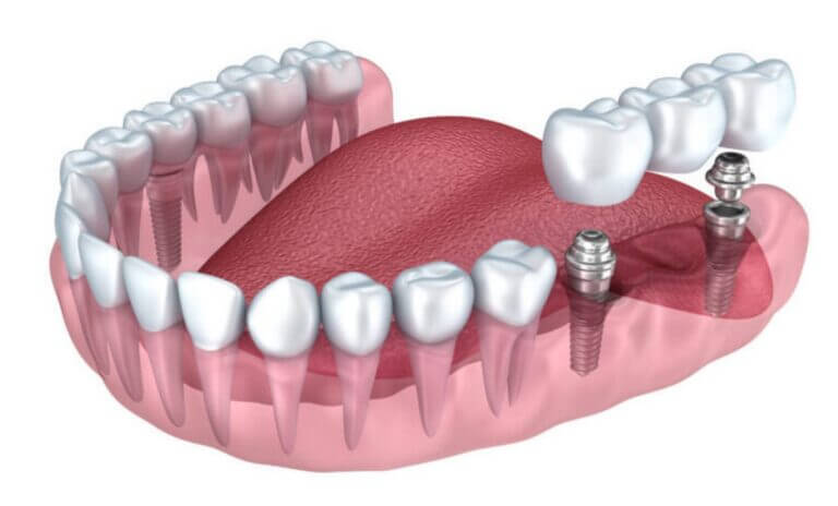 Best Brooklyn Dental Bridges: Cost, Insurance, Self-pay, types