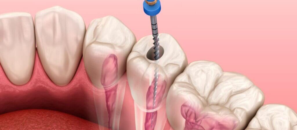 What Does a Root Canal Treat?