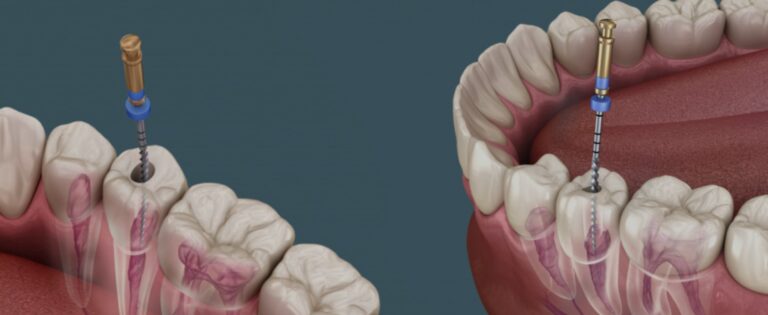 Best Root Canal Teeth treatment near me in Brooklyn, NY: Cost, Insurance, Self-pay options