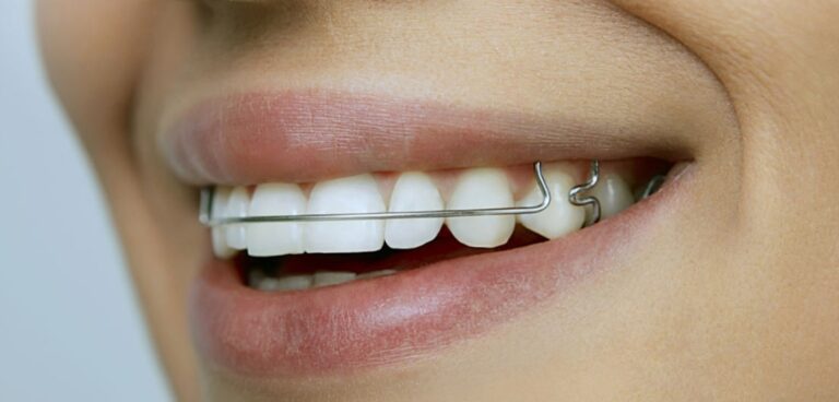ParkSide Dental Center Night Guards and Retainers: Cost, Insurance, Benefits