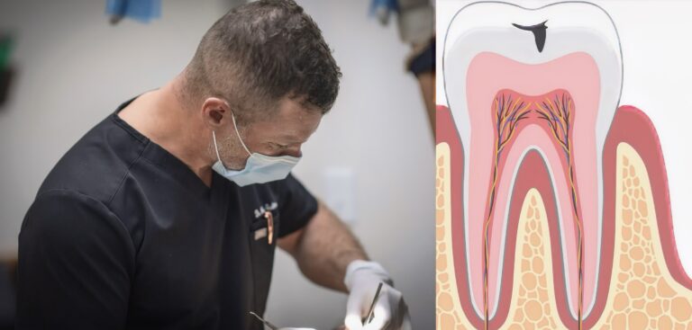 Hole in a Tooth Treatment: Stop Small Cavities Before They Become Big Problems