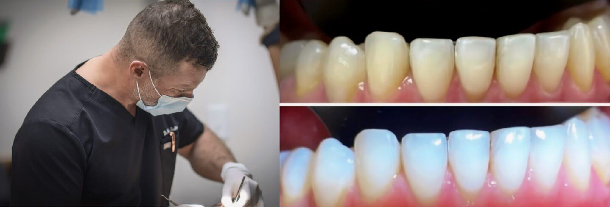 How Smoking Affects Teeth and Gums and How to Keep Your Teeth Healthy ...