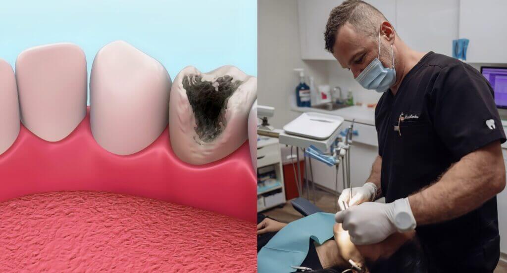 Understanding causes of tiny holes in teeth and enamel erosion symptoms can help in preventing the formation of tiny dental cavities