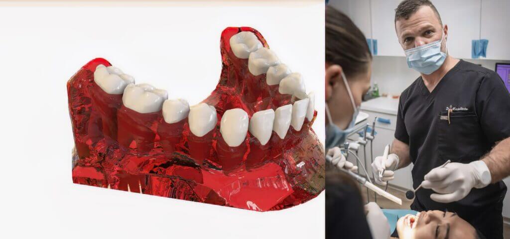 Benefits of Full Mouth Dental Implants at ParkSide Dental