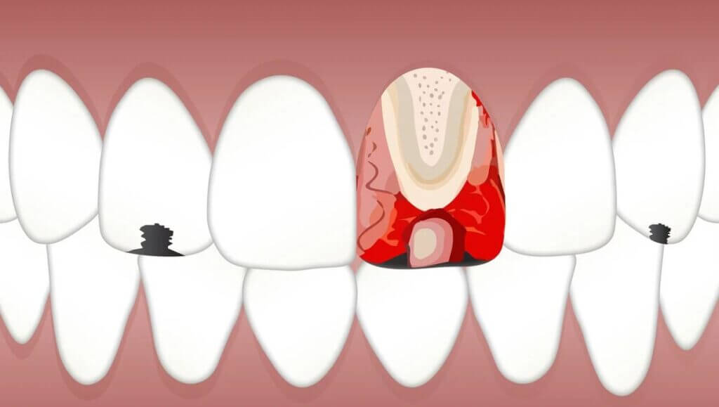 Pulpitis Treatment in Brooklyn