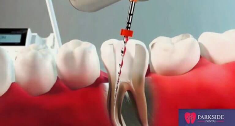 Pulpectomy vs. Root Canal: Understanding the Difference