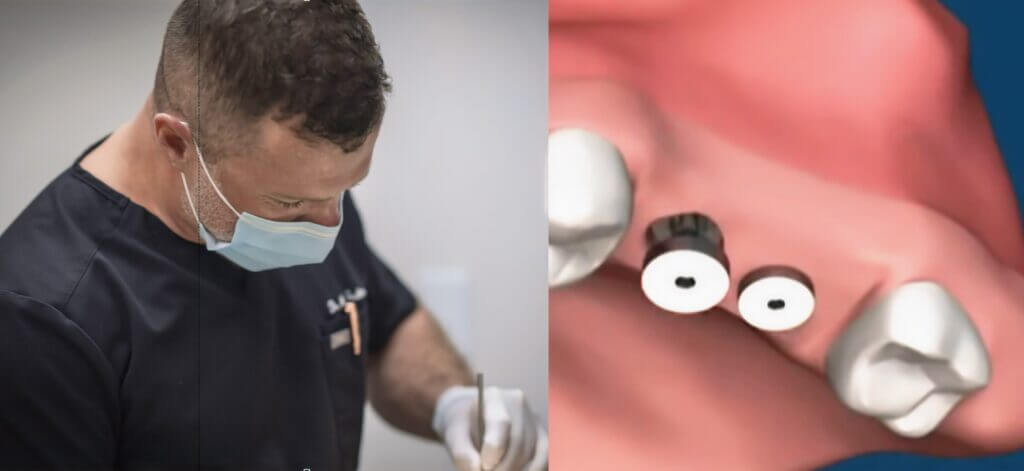 Insurance Coverage for Cracked Tooth Treatments