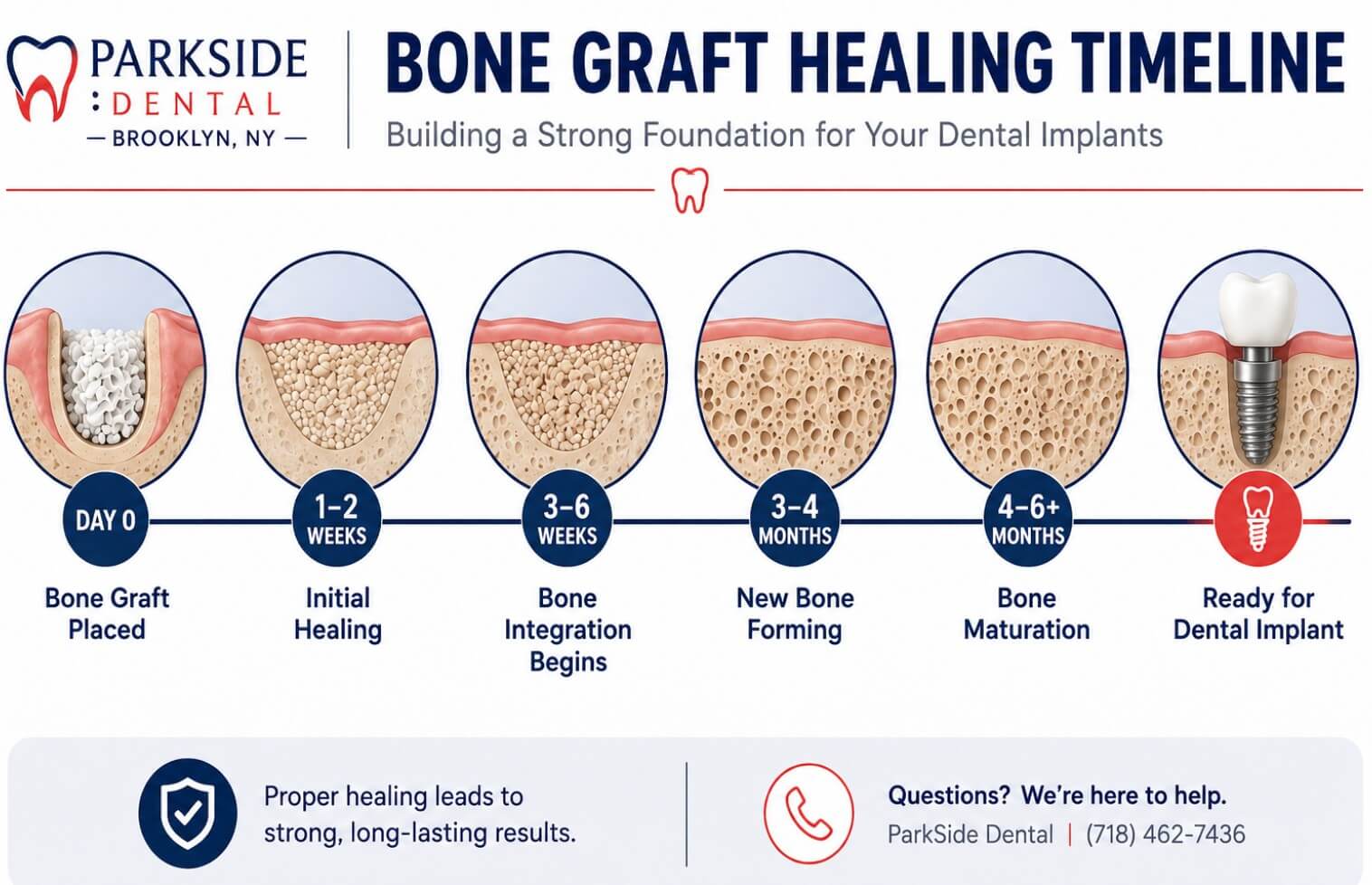 Bone graft healing timeline for dental implants at ParkSide Dental in Brooklyn, NY, from graft placement through implant readiness