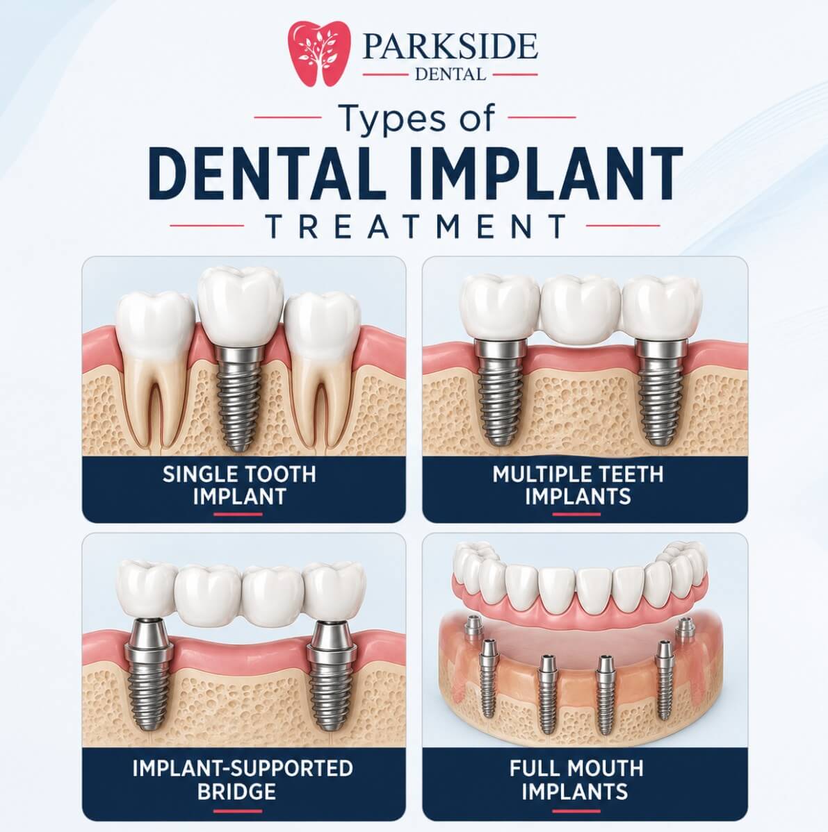 Types of dental implant treatment at ParkSide Dental in Brooklyn, NY, including single tooth, multiple teeth, implant-supported bridge and full mouth implants